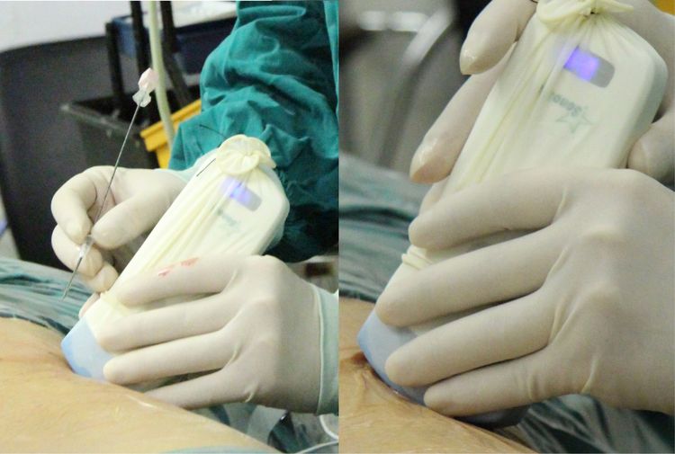 Application of Portable Imaging Technology by Handheld Ultrasound Manufacturers in Primary Care and 